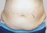 Exilis
