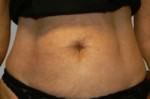 Exilis