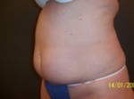 CoolSculpting