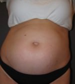 CoolSculpting