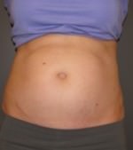 CoolSculpting