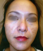 Obagi Blue Peel