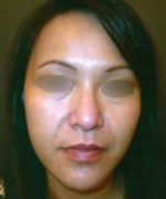 Obagi Blue Peel
