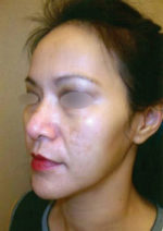 Obagi Blue Peel