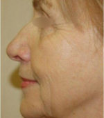 Exilis