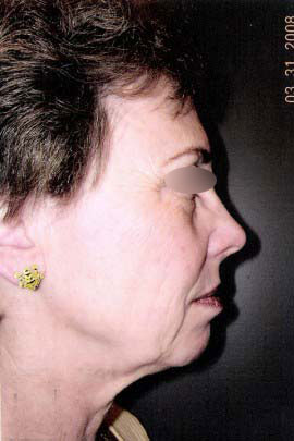 Facelift