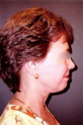 Facelift