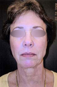 Facelift