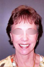 Facelift