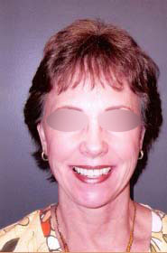 Facelift