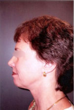 Facelift