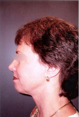 Facelift