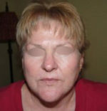 Facelift