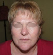 Facelift