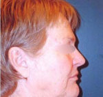 Facelift