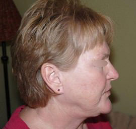 Facelift