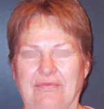 Facelift