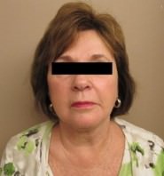 Facelift