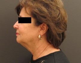 Facelift