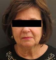Facelift