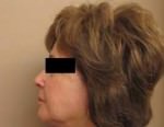 Facelift