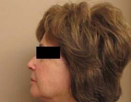 Facelift