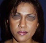 Nose Surgery