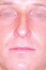 Nose Surgery