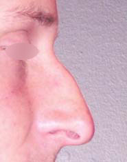 Nose Surgery
