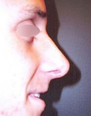 Nose Surgery
