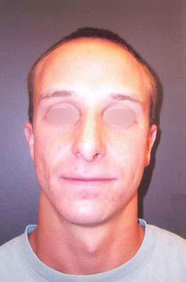 Nose Surgery