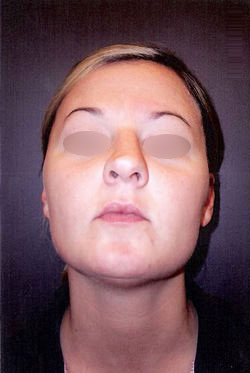 Nose Surgery