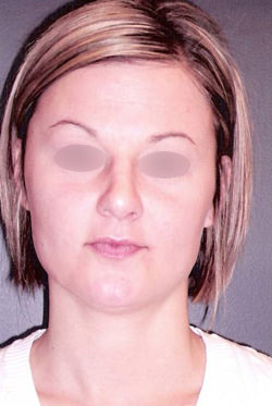 Nose Surgery
