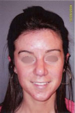 Nose Surgery