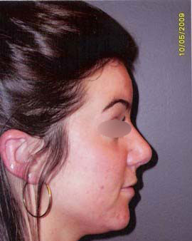 Nose Surgery
