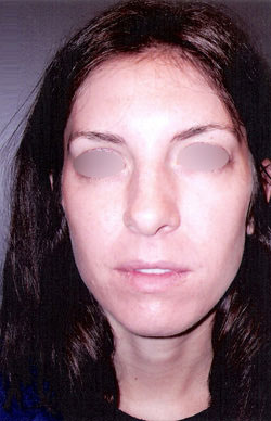 Nose Surgery