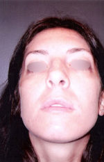 Nose Surgery