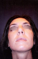 Nose Surgery