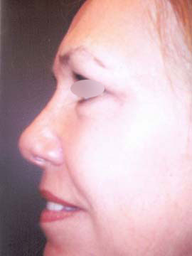 Nose Surgery