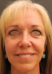 Nose Surgery