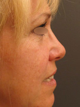 Nose Surgery