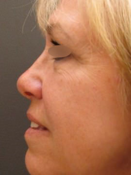 Nose Surgery