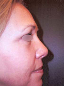 Nose Surgery