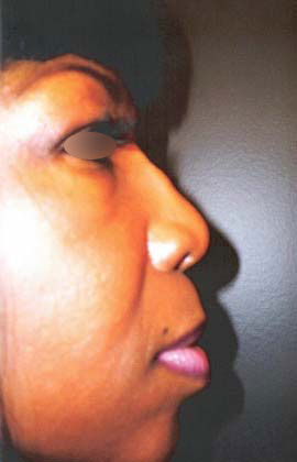 Nose Surgery