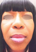 Nose Surgery