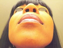 Nose Surgery