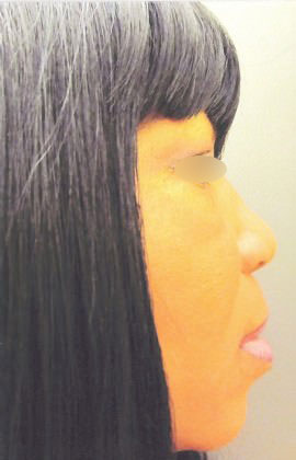 Nose Surgery