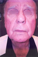Facelift