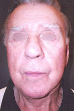 Facelift