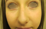 Nose Surgery